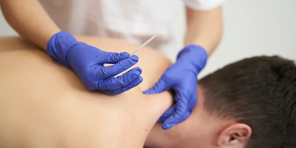 Dry needling therapy